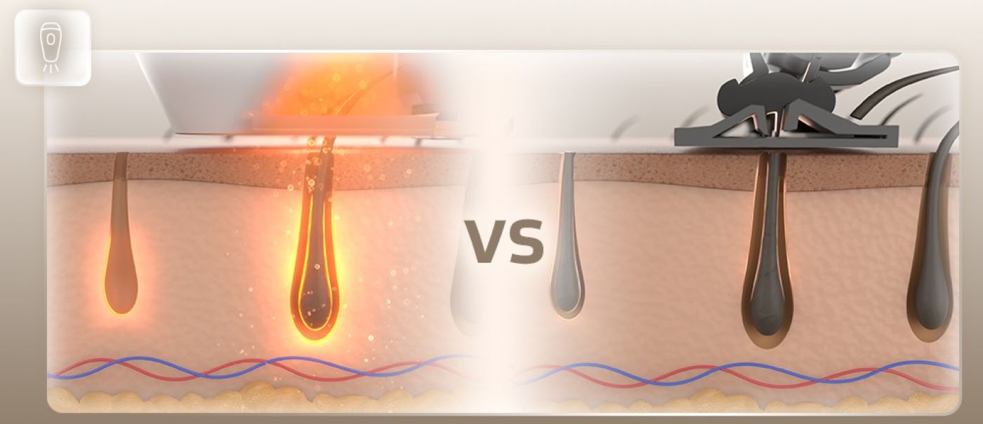 IPL epilátory naruší růstový proces chloupků na dlouhé měsíce.